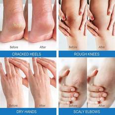 Urea Cream 40 percent for Feet Maximum Strength, Best Callus